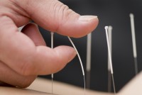 acupuncture back acupuncture back
